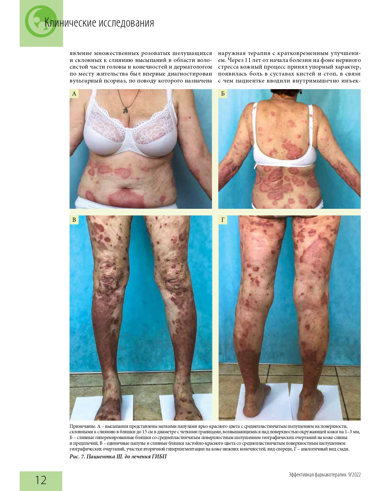 effektivnaya_farmakoterapiya_dermatovenerologiya_i_dermatokosmetologiya_1_2022_page-0014