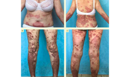 effektivnaya_farmakoterapiya_dermatovenerologiya_i_dermatokosmetologiya_1_2022_page-0014
