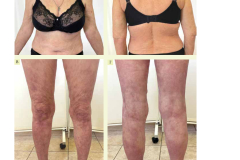 effektivnaya_farmakoterapiya_dermatovenerologiya_i_dermatokosmetologiya_1_2022_page-0017